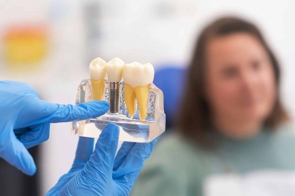 Les implants dentaires sont-ils disponibles à Saint-Jean-sur-Richelieu ?